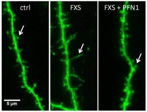 Nervenzellfortsätze (Dendriten) einer Kontroll-Maus, des FXS Mausmodells sowie des FXS Mausmodells, in dem die zu geringe Konzentration von PFN1 durch Manipulation der Genexpression erhöht wurde (Überexpression von PFN1). Die Pfeile deuten auf einzelne Synapsen hin. Diese haben im reifen Zustand eine pilzähnliche Form, bei FXS jedoch sind sie unreif und gleichen eher langen, dünnen Ästchen. Die zusätzliche Expression von PFN1 läßt die Synapsen reifen, so dass die Form nicht mehr vom der Kontrolle zu unterscheiden ist.